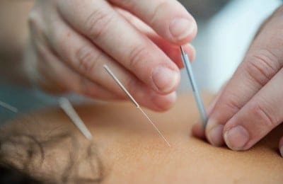 Add Some Needle To Your Digital Sleeve With Acupuncture SEO Services
