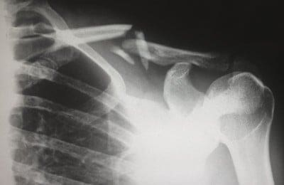 Find Your Perfect Personal Injury Leads Partner!